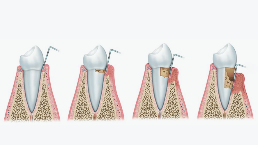 Maggok Dental_3. Gum Surgery: When Periodontal Flap Surgery Is Needed and the Treatment Process image 1