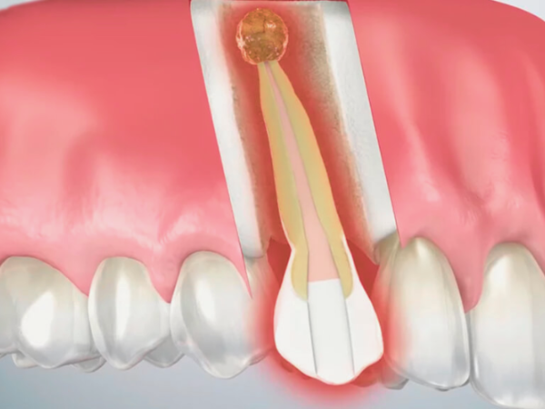 마곡동치과_&ldquo;신경치료했는데 또 아파요?&rdquo; [1. 치근단절제술이 필요한 경우] 관련 이미지 5