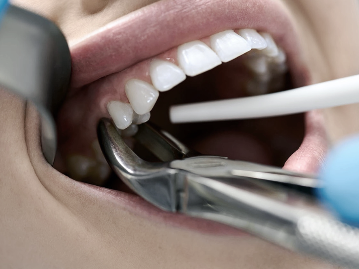 [마곡동치과_치아 흔들림 시리즈3] 흔들리는 이빨, 치료하면 다시 괜찮아질까요? 관련 이미지 1