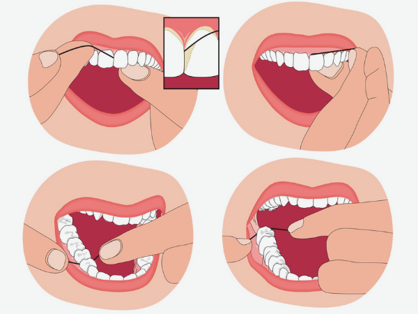 마곡동치과_3. 치실은 꼭 해야 할까요? 치아 사이 관리가 중요한 진짜 이유 관련 이미지 3