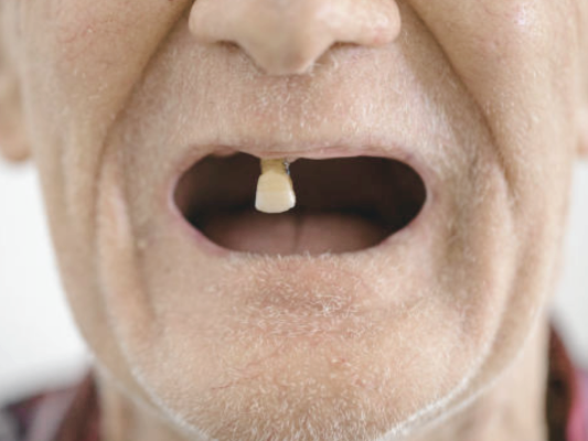 마곡역치과_1. 전악 임플란트란? 언제 필요한 치료일까요? 관련 이미지 2