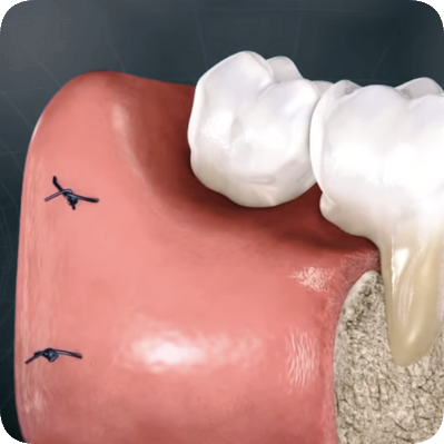 Maggok Dental_3. Gum Surgery: When Periodontal Flap Surgery Is Needed and the Treatment Process image 6