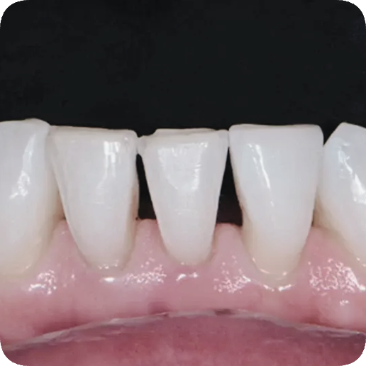 마곡동치과_3. 치주질환 자가진단 체크! 내 잇몸은 안전할까? 관련 이미지 5