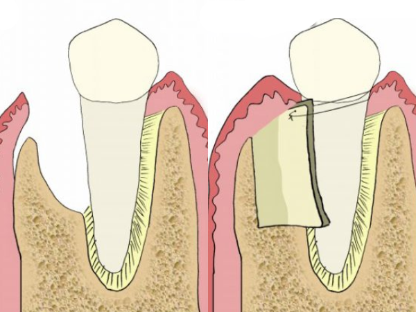 Maggok Dental_4. Is it over once the jawbone has melted away? How to save natural teeth with guided tissue regeneration (GTR) image 1