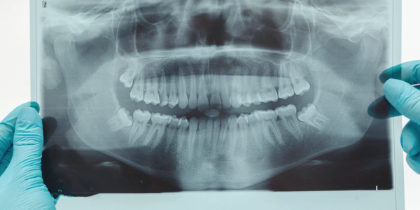 마곡동치과_4. 치주질환 진단검사로 잇몸병 진행 정도 바로 확인하세요! 관련 이미지 4