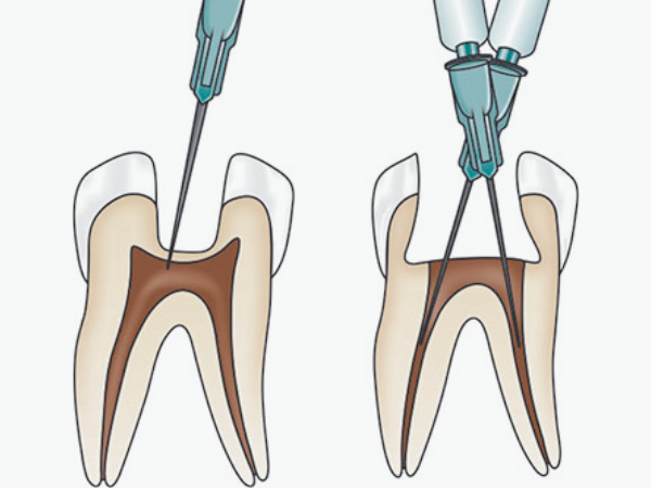 마곡동치과_1. 치과 국소마취, 종류별로 뭐가 다를까요? 관련 이미지 5