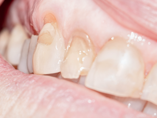 마곡동치과_ "교모, 치경부마모, 침식 중 어디에 해당할까?" [2. 치아마모 종류] 관련 이미지 4