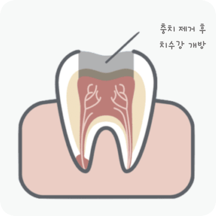 마곡동치과_ "치아 속 구조 복원 프로젝트" [2. 신경치료 단계별 진행 과정 ] 관련 이미지 2