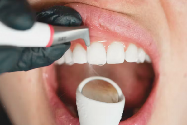 마곡치과_"긁지 말고, 부드럽게 관리!" [ 2. 임플란트 전용 에어플로우 스케일링 ] 관련 이미지 3