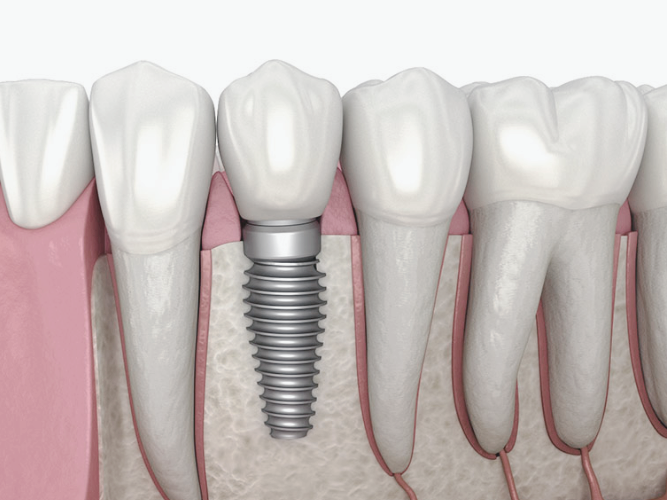 마곡동치과_1. 임플란트 치료에 관련 이미지 1