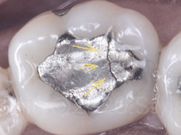 마곡치과_2. 오래된 아말감, 언제 교체해야 할까요? 꼭 확인해야 할 5가지 신호 관련 이미지 1