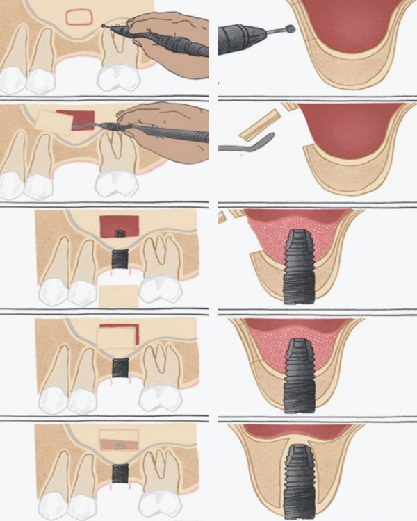 마곡치과_3. 상악동 거상술 측방 접근법, 언제 어떻게 진행될까? 관련 이미지 4