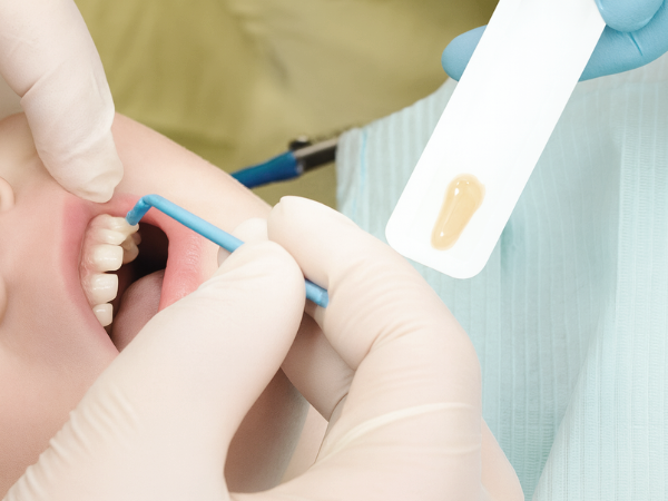 마곡역치과_&ldquo;바니시, 이렇게 진행됩니다!&rdquo; [3. 치과 불소도포 과정] 관련 이미지 1