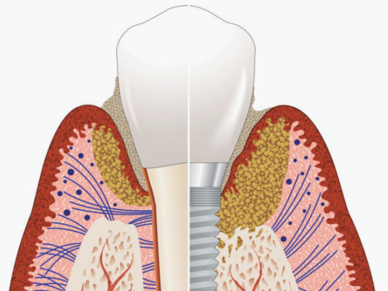 마곡역치과_&ldquo;괜찮겠지?&rdquo; 방심하다가 큰일! [ 1. 임플란트 주위염 3가지 증상 ] 관련 이미지 5