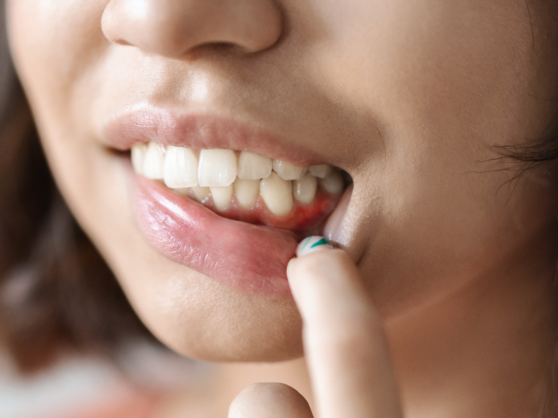 마곡동치과_ 6. 스케일링 후 주의사항, 이것만 알면 잇몸 걱정 끝! 관련 이미지 1