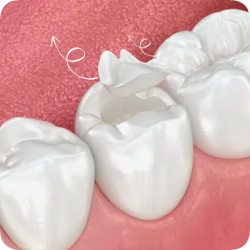 마곡역치과_5. 인레이 보철물 떨어지는 이유 [ 탈락 원인과 재접착 가능한 경우는? ] 관련 이미지 8