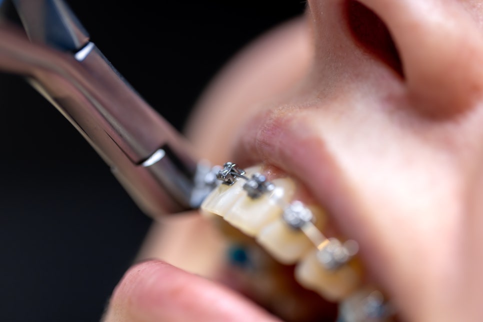 [ Magok Dental Clinic_02 ] Wisdom tooth extraction: If this applies, you should no longer put it off image 5