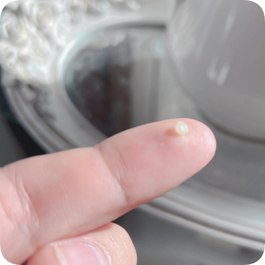 마곡동치과_1. 인레이 보철 치료, 언제 필요한가요?[ 치료 시기와 증상 정리 ] 관련 이미지 6