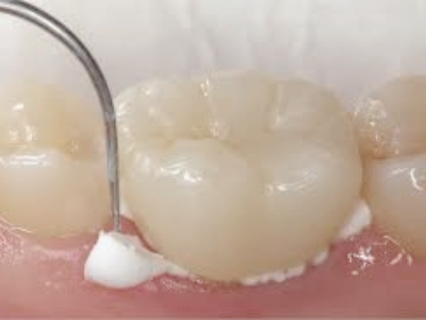 마곡역치과_4. 크라운 치료 후 통증? 불편감이 생기는 8가지 이유 관련 이미지 2