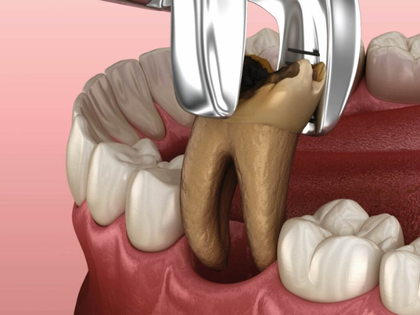 마곡역치과_ &ldquo;얼음물 한 모금에 찌릿?&rdquo;[1. 치수염 원인과 증상] 관련 이미지 6