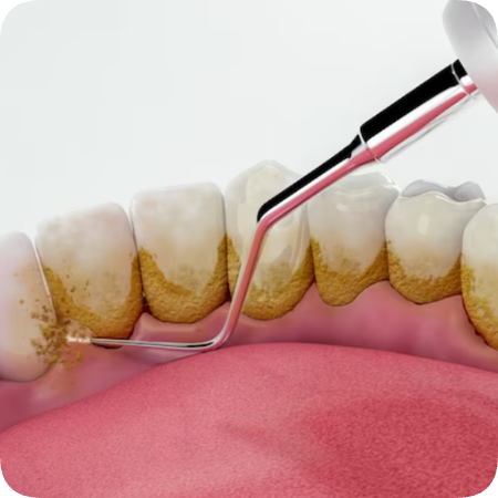 마곡치과_"스케일링에도 스타일이 있다?" [ 3. 에어플로우와 일반 스케일링 비교 ] 관련 이미지 5