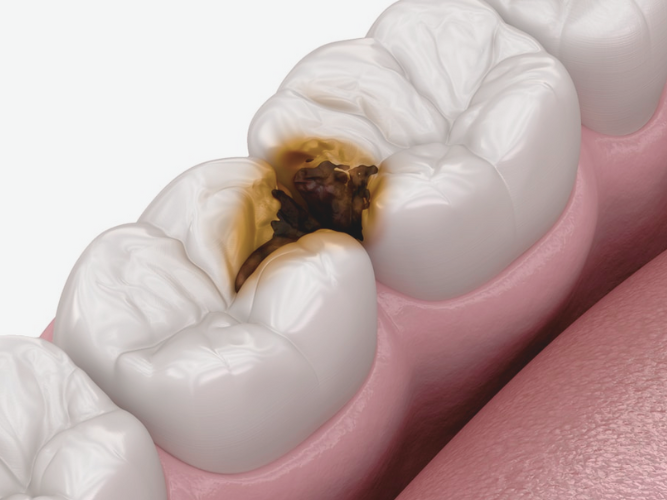 마곡동치과_ &ldquo;이럴 때 치아 본을 떠야 합니다!&rdquo; [2. 인상채득이 필요한 경우] 관련 이미지 1