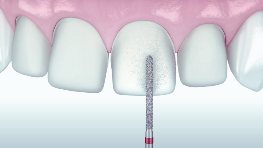 마곡역치과_3. 무삭제 라미네이트(디아네이트) 시술 과정 관련 이미지 6