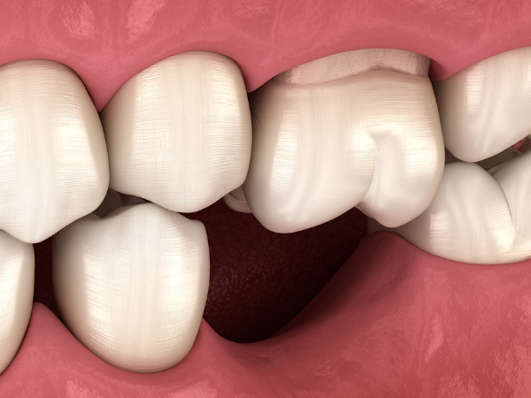 마곡동치과_2. 잇몸재생주사 PDRN, 효과를 기대해도 되는 경우 vs 어려운 경우 관련 이미지 5