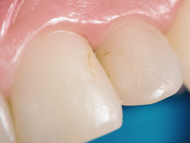 마곡역치과_3. 레진변색, 디아네이트 무삭제 라미네이트 케이스 관련 이미지 1