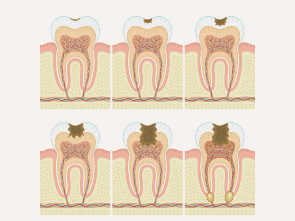 Maguok Station Dental Clinic_3. Do I Really Need Dental X-rays? The Real Problems Visible Only Through Radiographic Exams image 1
