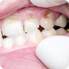 마곡치과_"이럴 땐 레진이 답입니다" [ 1. 치과 레진 활용법 ] 관련 이미지 4