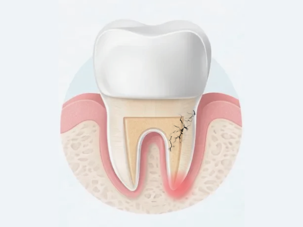마곡치과_1. 재신경치료 필요한 이유, 신경치료 후 통증 왜 다시 아플까요? 관련 이미지 3