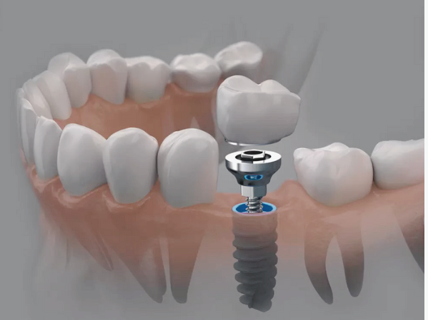 마곡동치과_ &ldquo;안전한 준비, 깔끔한 진행!&rdquo; [ 4. 당일 임플란트 수술 과정 ] 관련 이미지 5