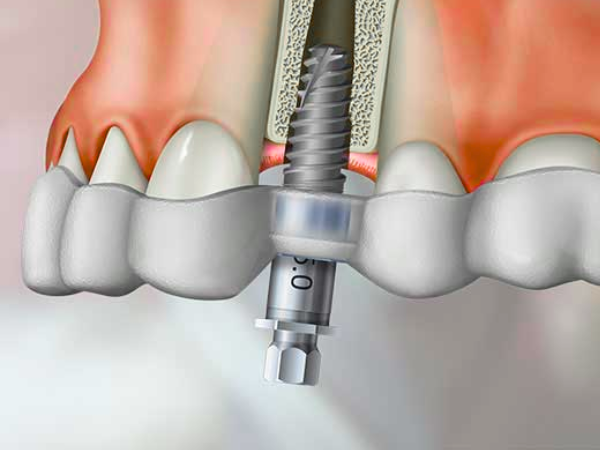 마곡동치과_&ldquo;붓기, 통증 줄이고 회복은 빠르게!&rdquo;[3. 3D 네비게이션 임플란트 회복 과정 ] 관련 이미지 1