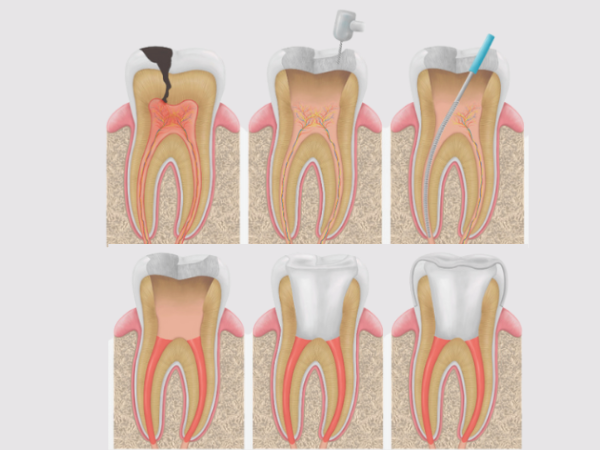 마곡역치과_4. 치수염이면 무조건 신경치료 해야 할까요? 단계별 기준 정리 관련 이미지 4