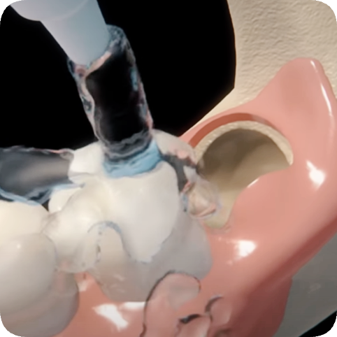 마곡역치과_4. 사랑니 발치, 어떤 과정을 거치나요? 관련 이미지 7