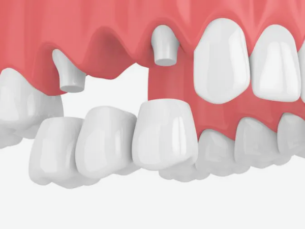 마곡역치과_4. 브릿지 치료 단점과 수명, 얼마나 오래 사용할 수 있을까요? 관련 이미지 4