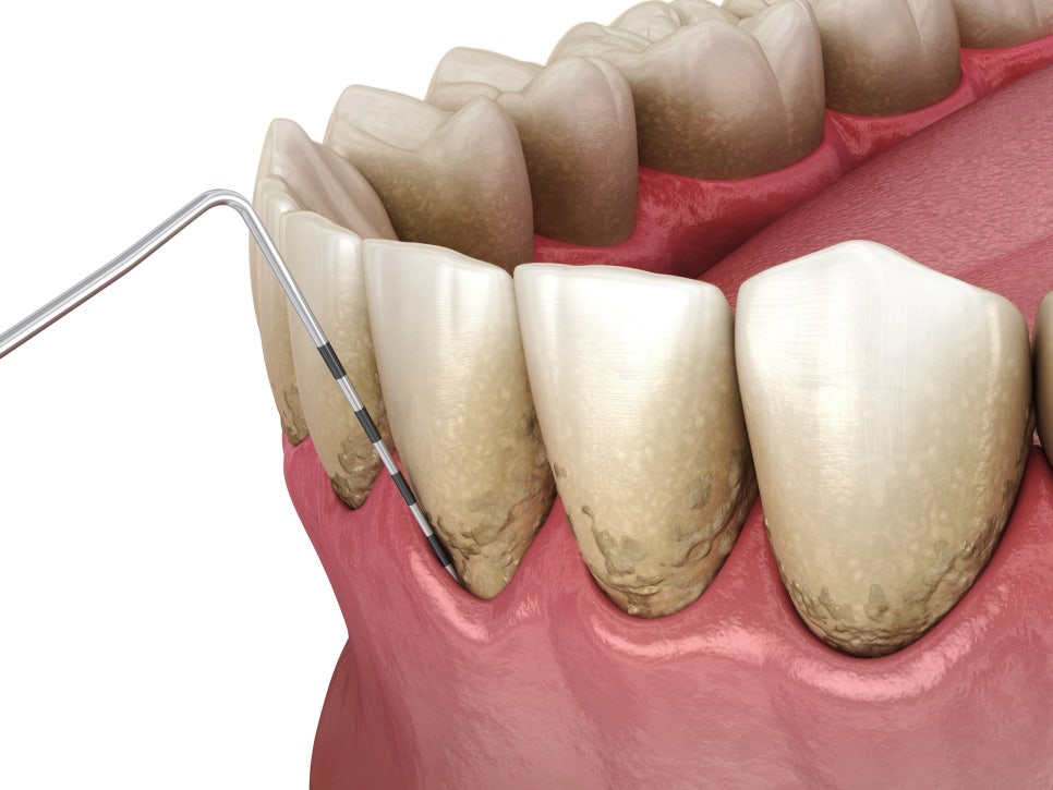 마곡치과_" 찬 음식 앞에서 움찔!" [ 1. 시린이(지각과민증) 원인 ] 관련 이미지 7