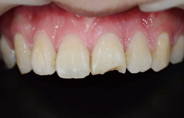 마곡동치과_4. 무삭제 라미네이트(디아네이트) 리얼 후기 3가지 케이스 관련 이미지 3