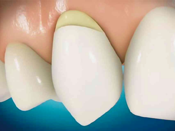 마곡동치과_ "교모, 치경부마모, 침식 중 어디에 해당할까?" [2. 치아마모 종류] 관련 이미지 2