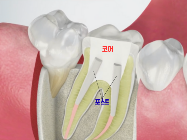 마곡역치과_ "크라운 씌우기 전, 코어와 포스트 꼭 해야 하나요?" [6. 신경치료 후 보강치료 필요성 ] 관련 이미지 1