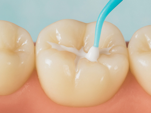 마곡역치과_3. 학령기,청소년(8~18세) 충치 증가 이유와 구강관리 핵심 관련 이미지 2