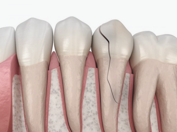 마곡역치과_&ldquo;괜찮겠지 했다가 더 커집니다&rdquo;[4. 금간 치아 방치 시 발생하는 문제] 관련 이미지 4