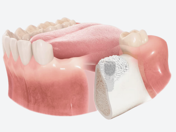 마곡동치과_4. 임플란트 뼈이식 비용과 결정 요인 관련 이미지 5