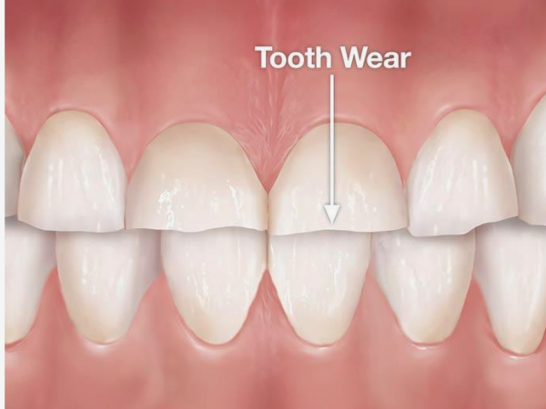 마곡동치과_ "찬물에 시리고, 이가 짧아졌다면?"[3. 치아마모 증상] 관련 이미지 5