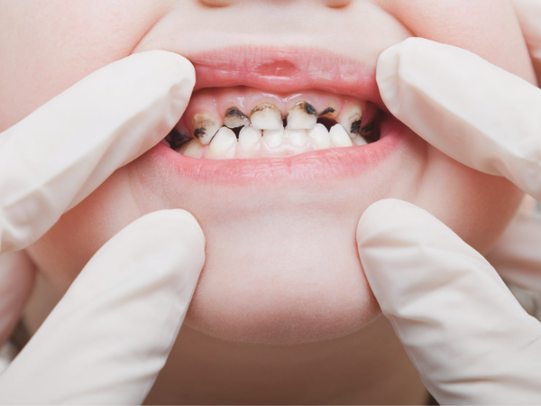 마곡동치과_1. 영유아 구강관리(0~3세), 첫 치아부터 꼭 알아야 할 관리법 관련 이미지 4