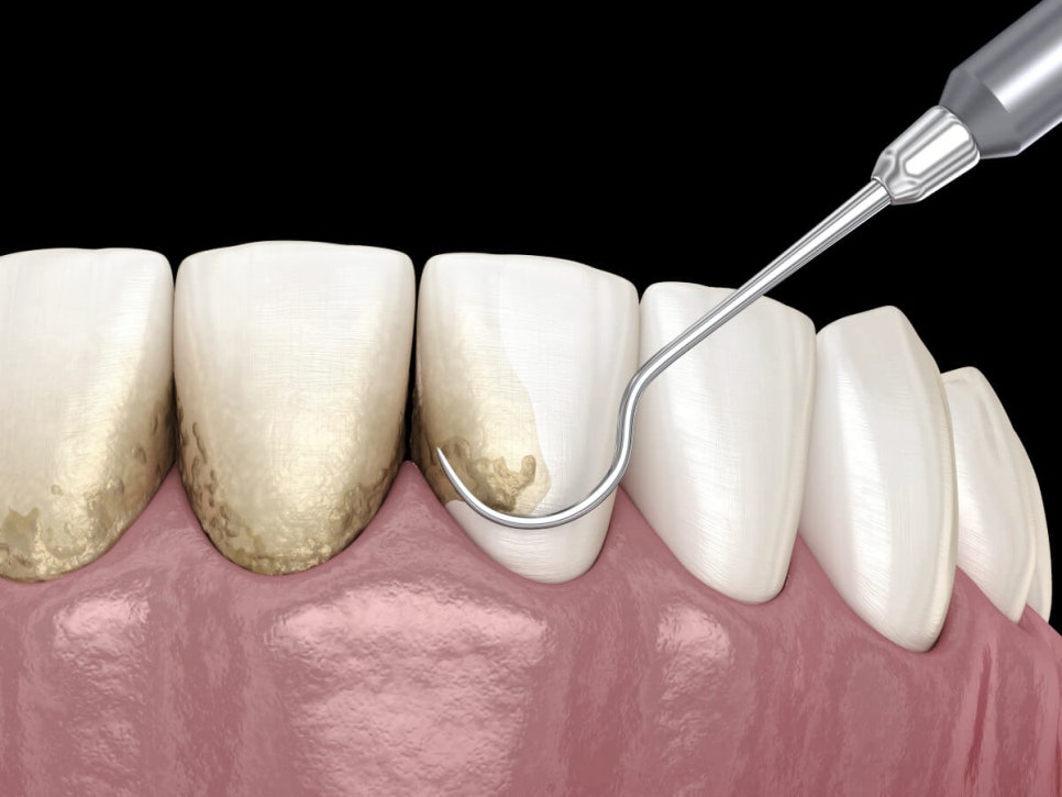 마곡동치과_ 1. 치석 제거는 기본! 스케일링 효과 5가지 총정리 관련 이미지 1