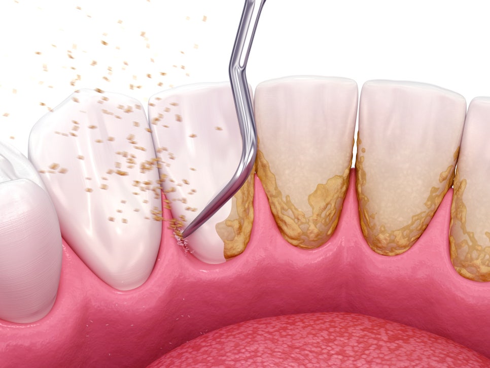 마곡역치과_5. 무삭제 라미네이트(디아네이트) 후 관리법, 이것만 지키면 오래갑니다! 관련 이미지 2