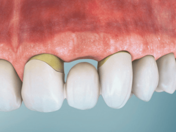 마곡역치과_4. 브릿지 치료 단점과 수명, 얼마나 오래 사용할 수 있을까요? 관련 이미지 3