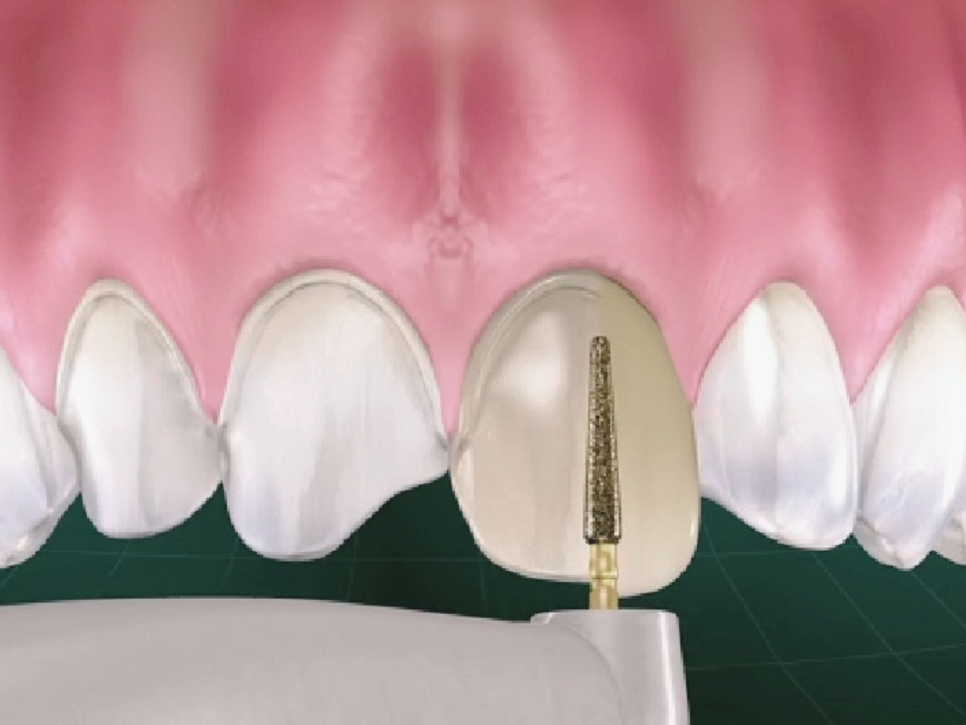 마곡치과_  1. 무삭제 라미네이트가 가능한 경우 ( feat. 디아네이트) 관련 이미지 3